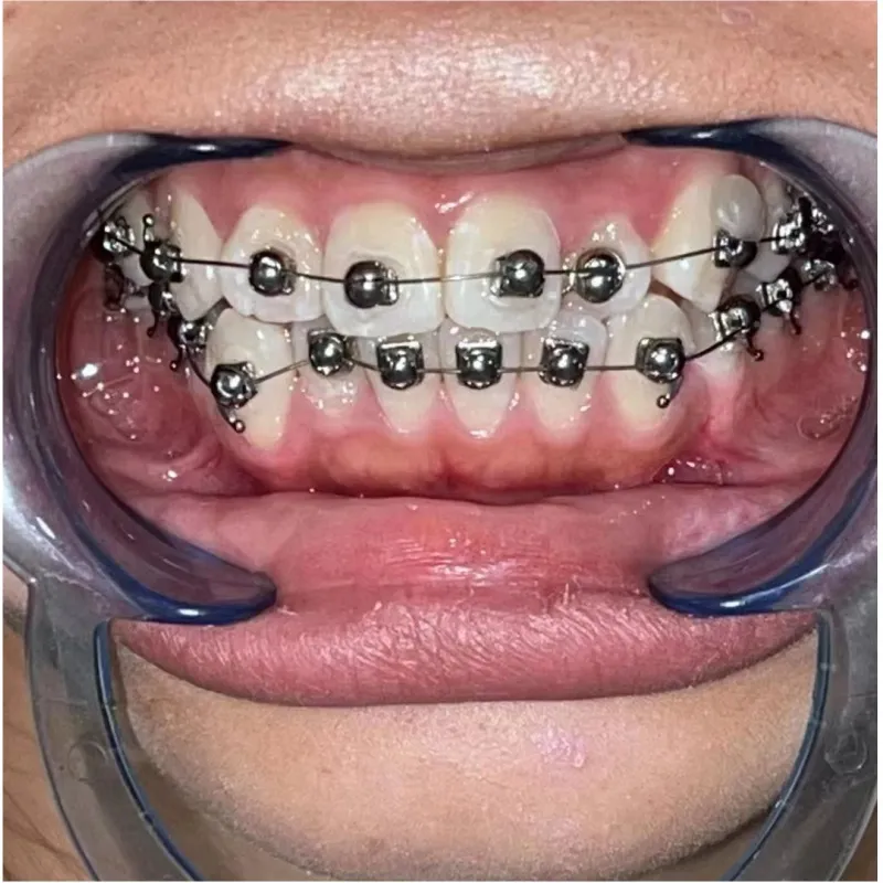 Dental Bracket Detail 2