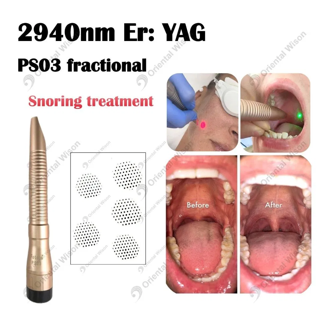 Erbium YAG Laser 2940nm Face Lifting Dental Laser Stretch Mark Removal 1064nm ND YAG Long Pulse Laser Hair Removal for Clinic Use