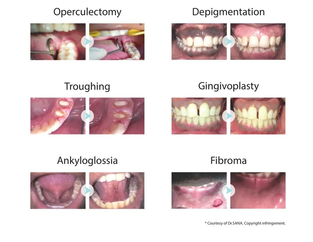 Dental Laser Treatment Detail