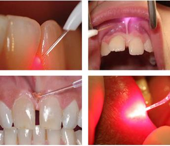 60W Dental Diode Laser Surgery Price Soft Tissue Cutting Dental Hard Tissue Laser Dental Laser Teeth Whitening Machine