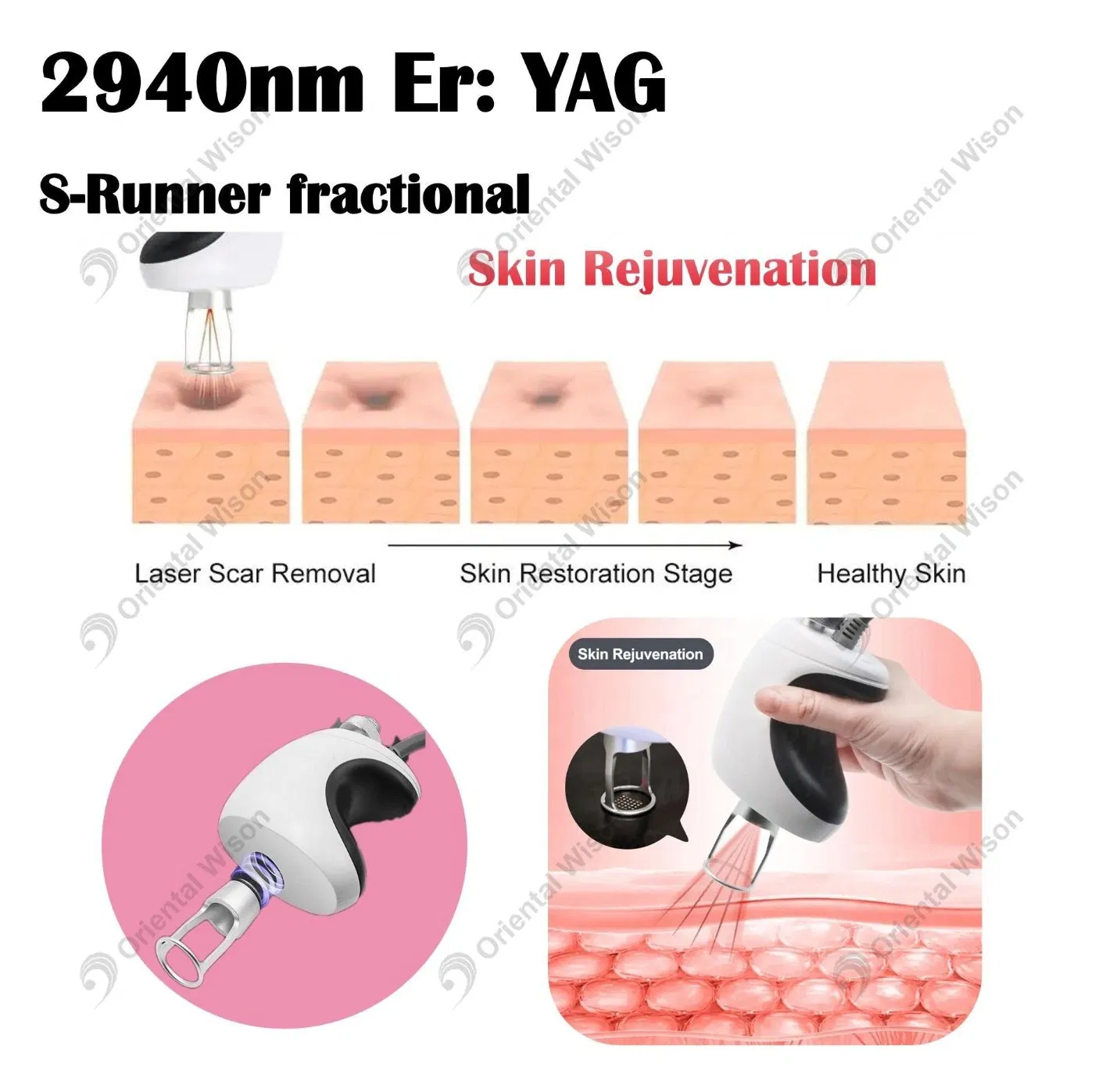 Erbium YAG Laser 2940nm Face Lifting Dental Laser Stretch Mark Removal 1064nm ND YAG Long Pulse Laser Hair Removal for Clinic Use
