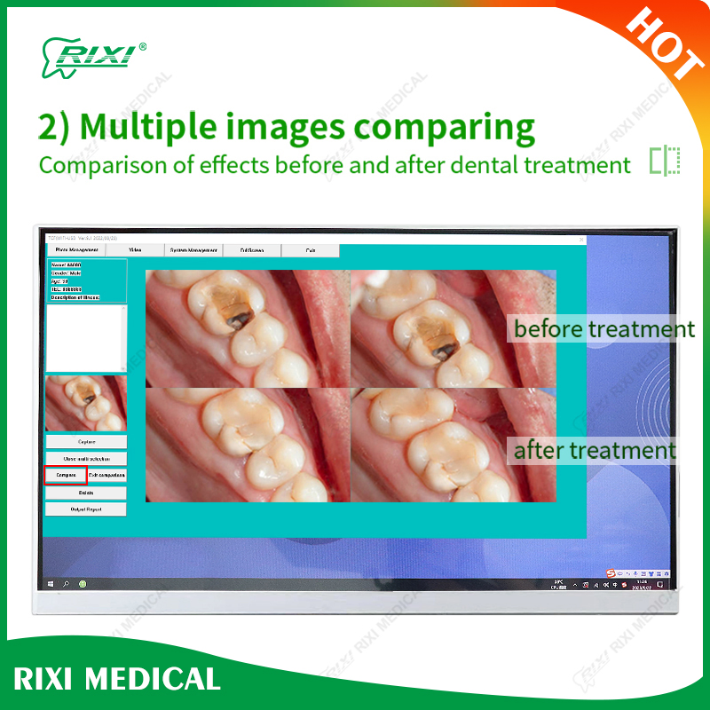 OEM CE Approved Intraoral Rixi Material Instrument Handpiece Advanced Equipment Dental Oral Camera