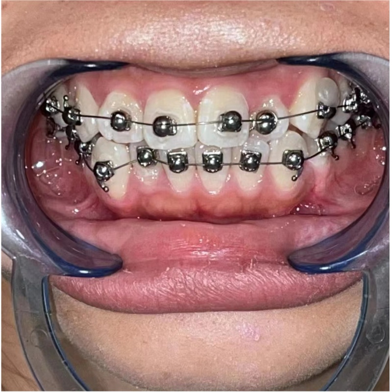 Round Ball Shape Dental Orthodontic Q Type Self-Ligating Bracket