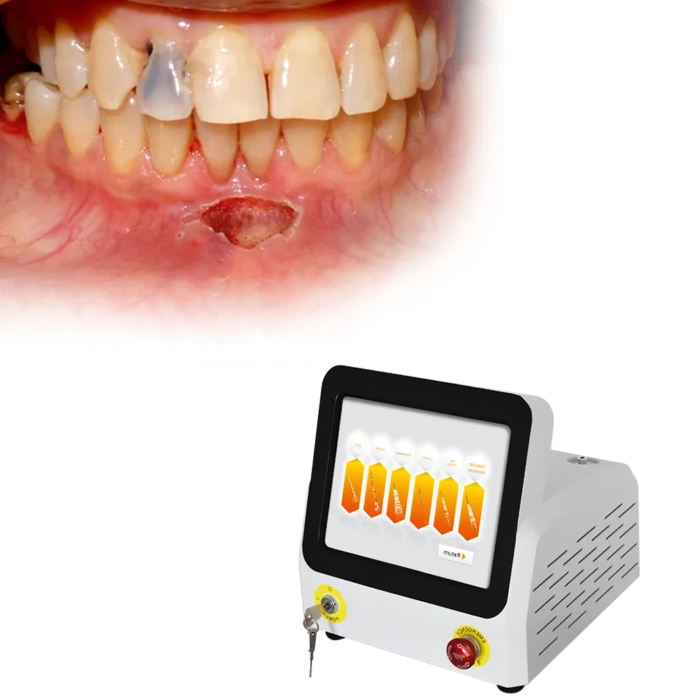 Hot Sale Portable 980nm 30W 60W Dental Soft Tissue Laser Therapy Hard Tissue Whitening Dental Laser Device