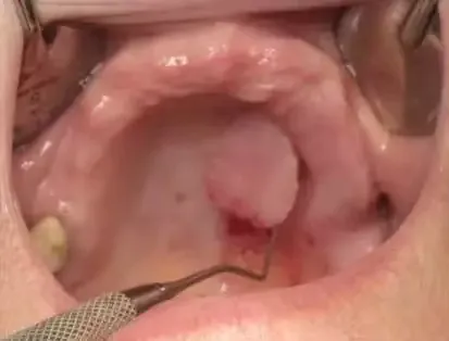 Dental Laser Accessory 3