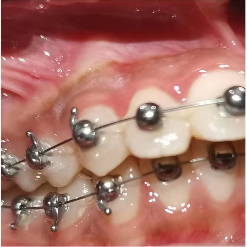 Round Ball Shape Dental Orthodontic Q Type Self-Ligating Bracket