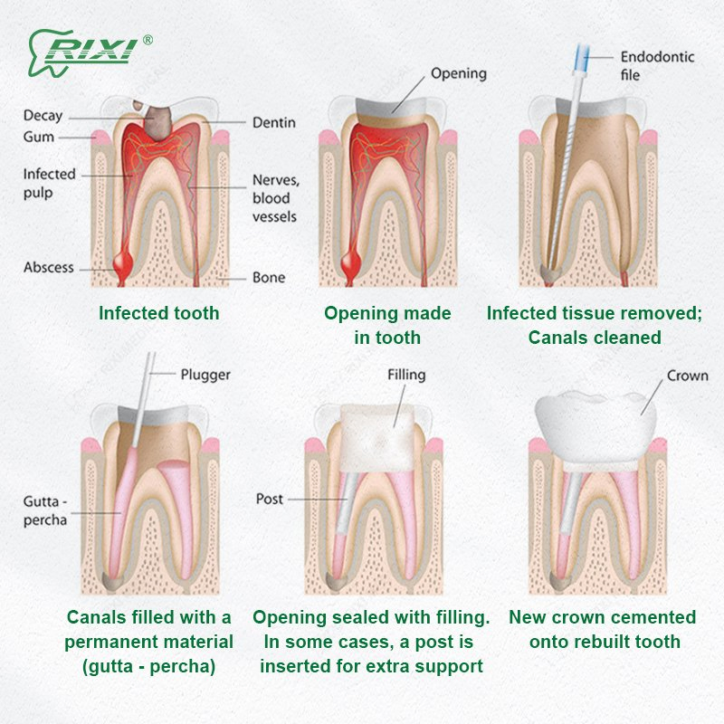 Specialized Instrument Equipment Durable Rixi Reliable Dental Endodontic Rotary Files