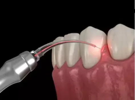 Dental Laser Accessory 1