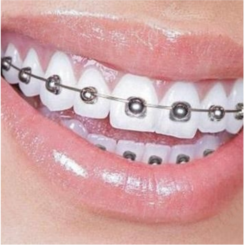 Round Ball Shape Dental Orthodontic Q Type Self-Ligating Bracket