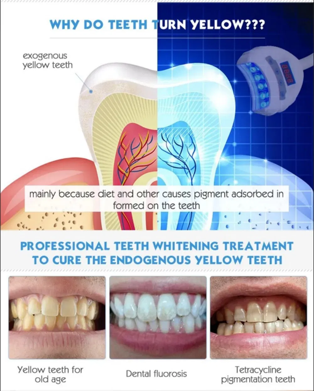 Dental Bleaching Lamp