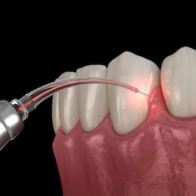 Soft Tissue 3 in 1 Diode Whitening Machine Dental Laser Device