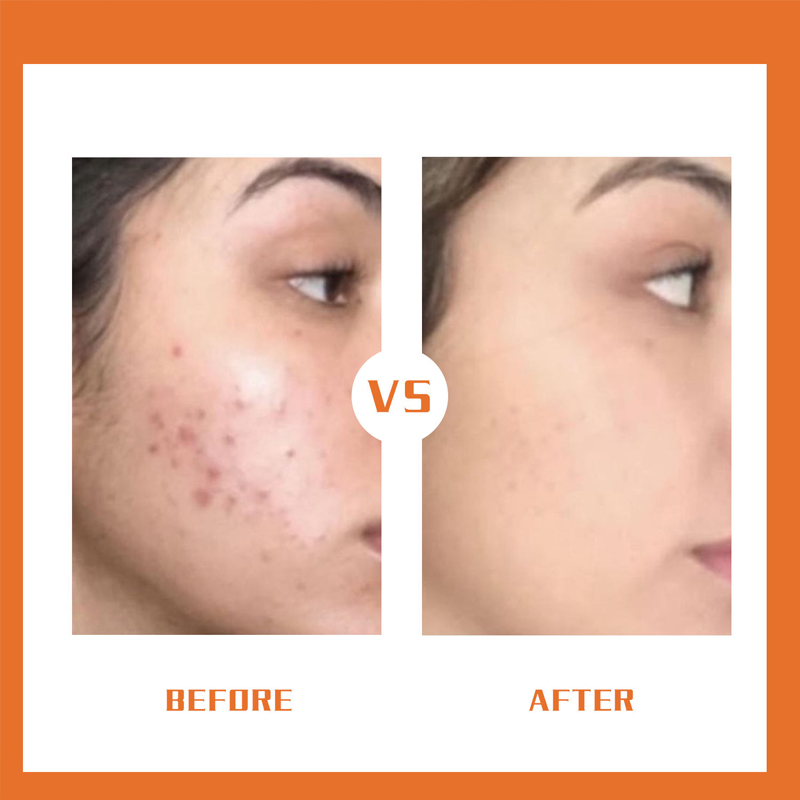 Wholesale 2% Salicylic Acid Exfoliating Facial Serum for Acne Scars and Dark Spots