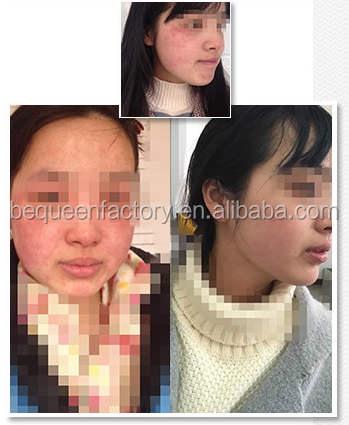 Whitening Capsule Serum for Acne Treatment and Skin Repairing