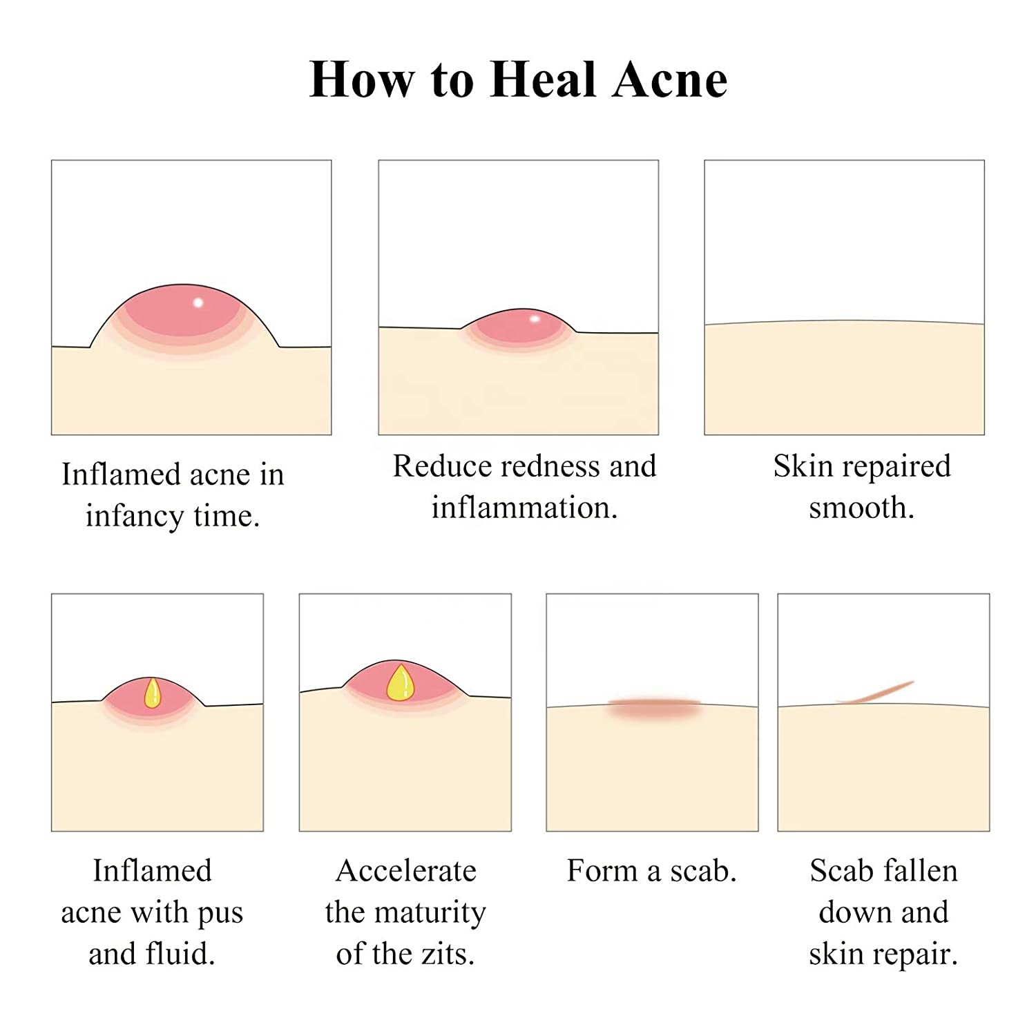 Wholesale Private Label Face Skin Product Tea Tree Acne Treatment Serum for Clearing Severe Acne, Breakout, Remover Pimple