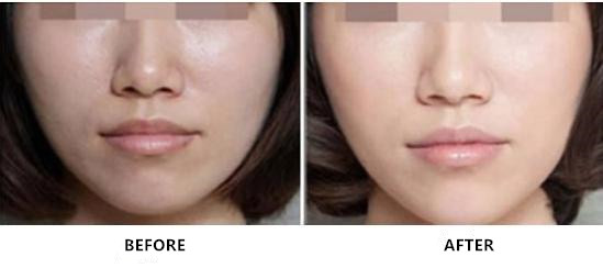 PDRN Serum