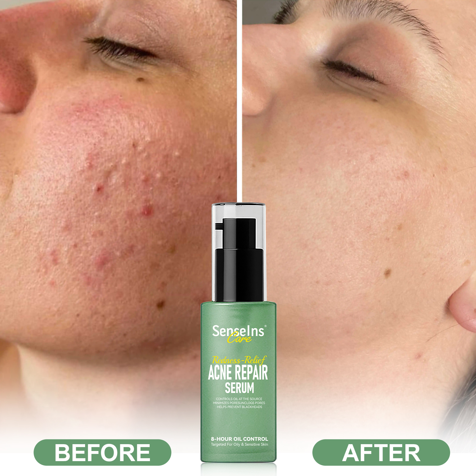 Hot Selling Acne Repair Serum Private Label Organic Soothing Whitening Acne Remove Anti-Acne Dark Spots Correcting Face Serum