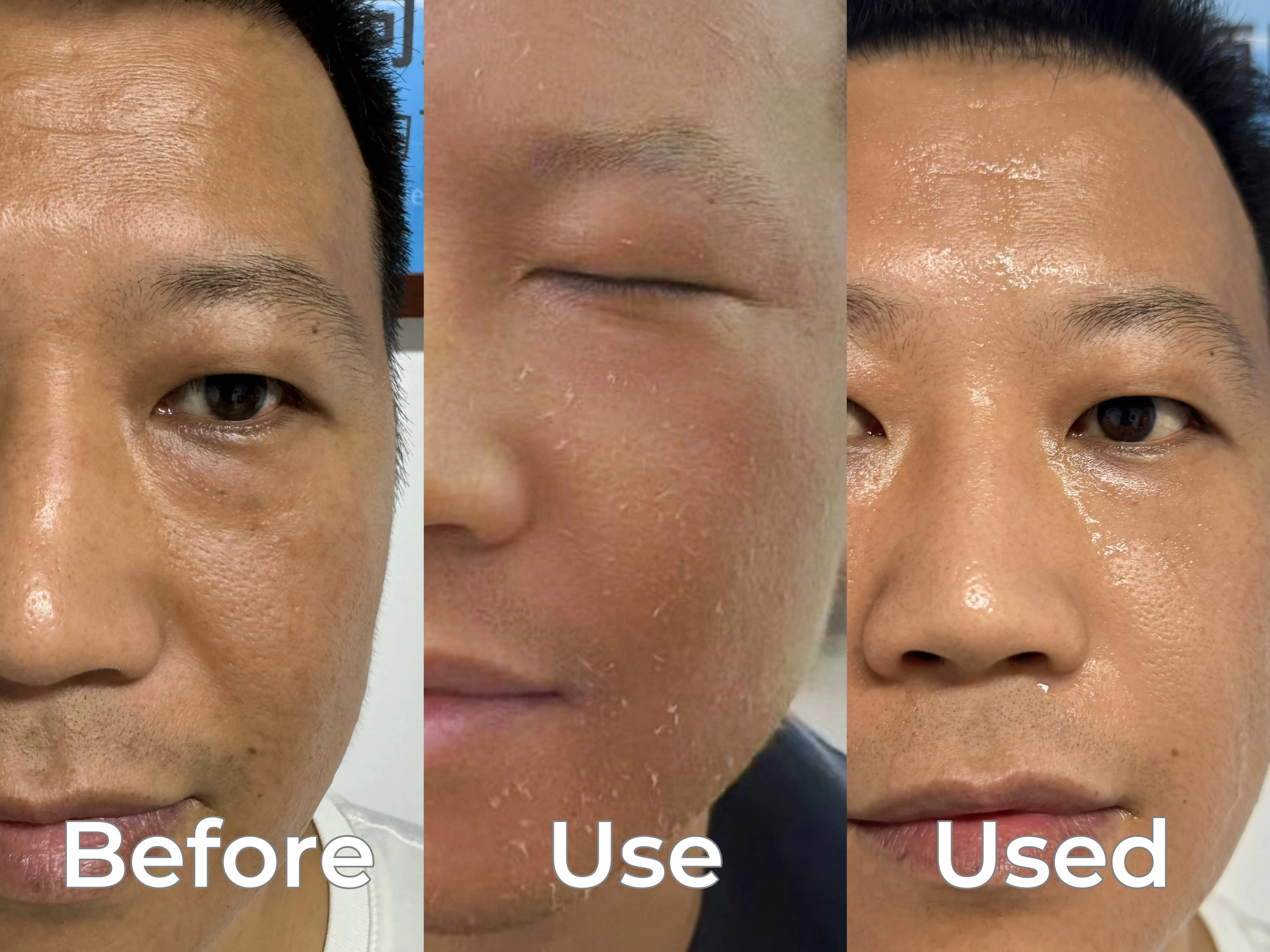 Salicylic Acid Melasma Instant Remover Peel Serum Dark Spot Correction Skin Peeling Solution Chemical Peel for Face Professional
