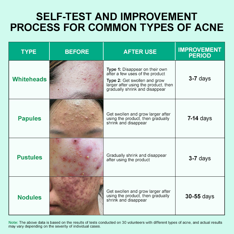 Acne Serum Product Display 6