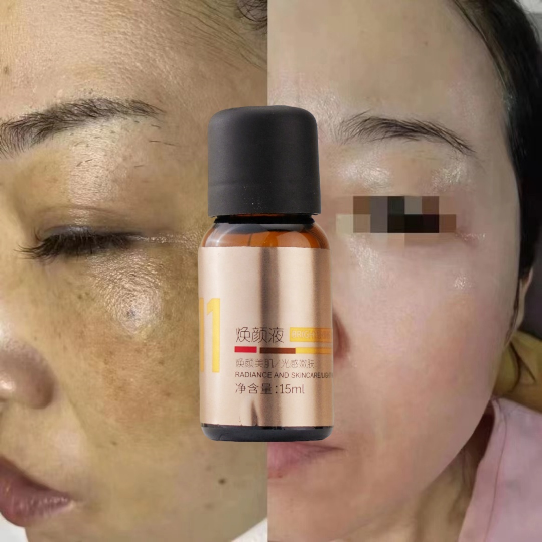 Salicylic Acid Melasma Instant Remover Peel Serum Dark Spot Correction Skin Peeling Solution Chemical Peel for Face Professional