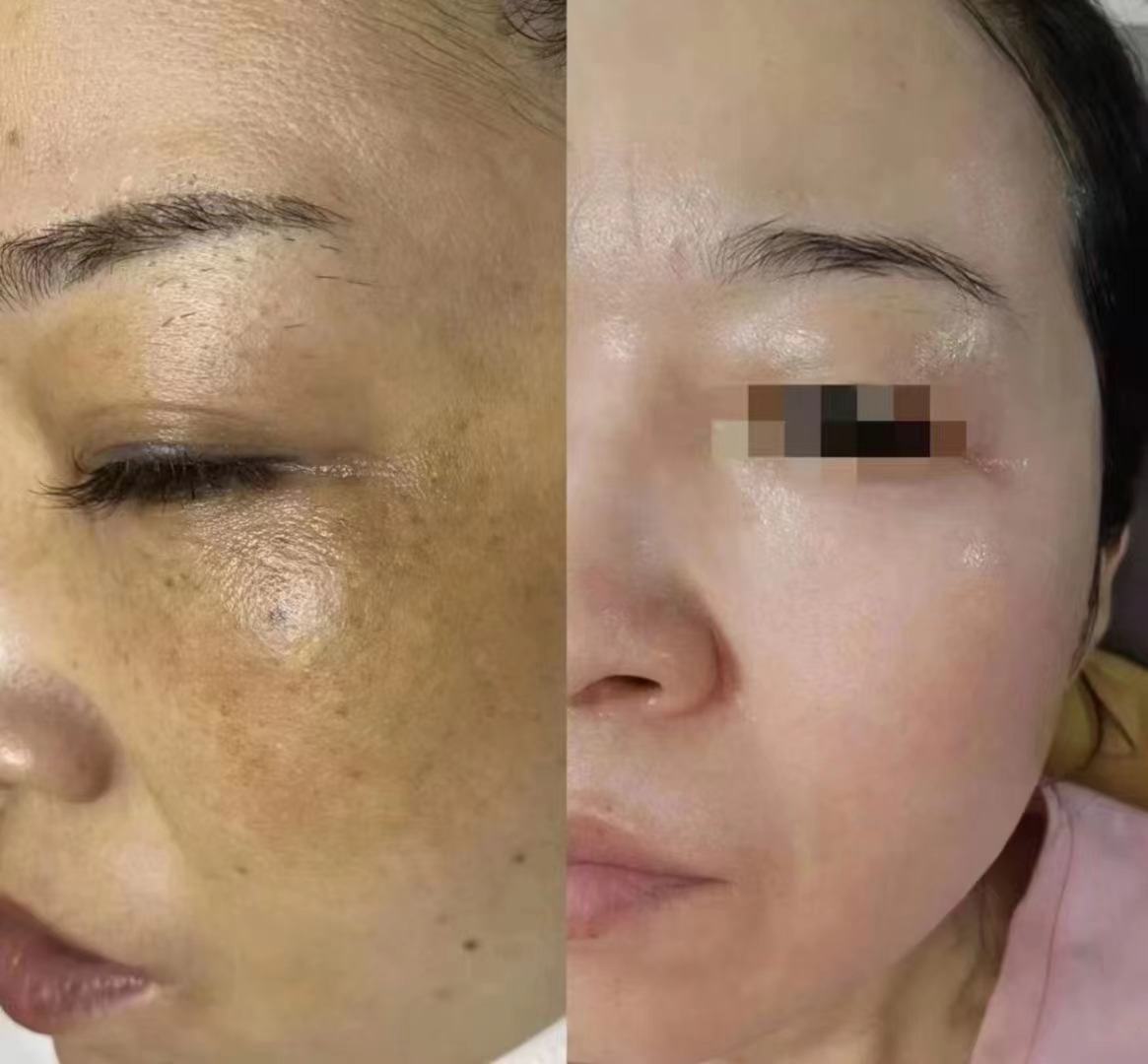 Salicylic Acid Melasma Instant Remover Peel Serum Dark Spot Correction Skin Peeling Solution Chemical Peel for Face Professional