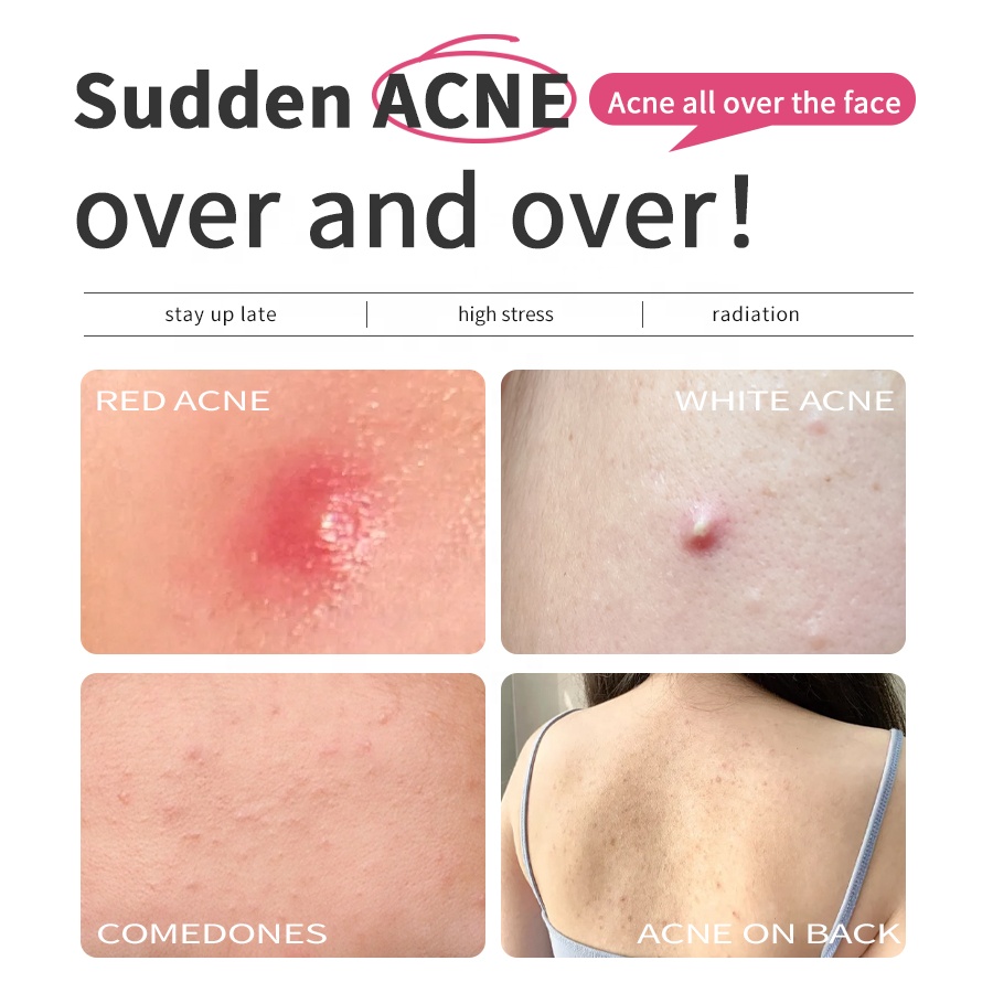 Private Brand OEM Skin Care Products Whitening Acne Removal and Facial Repair Serum