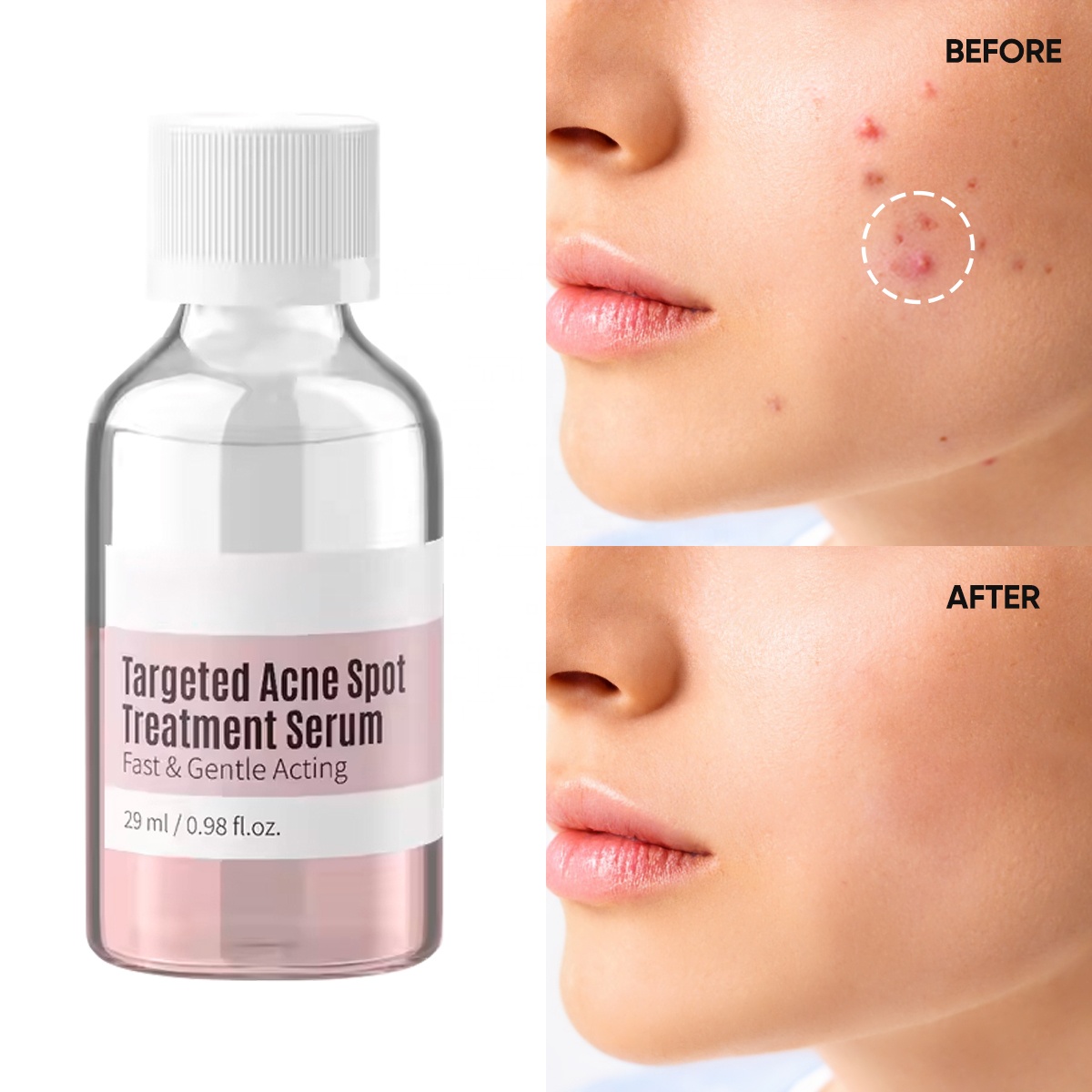 Private Brand OEM Skin Care Products Whitening Acne Removal and Facial Repair Serum