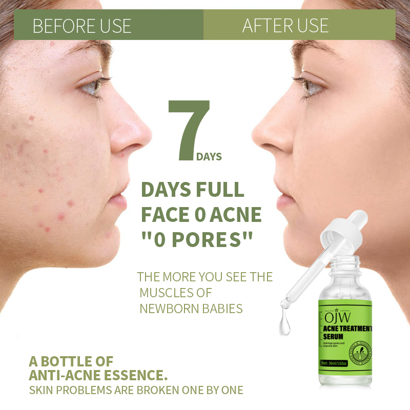 Acne Serum 5