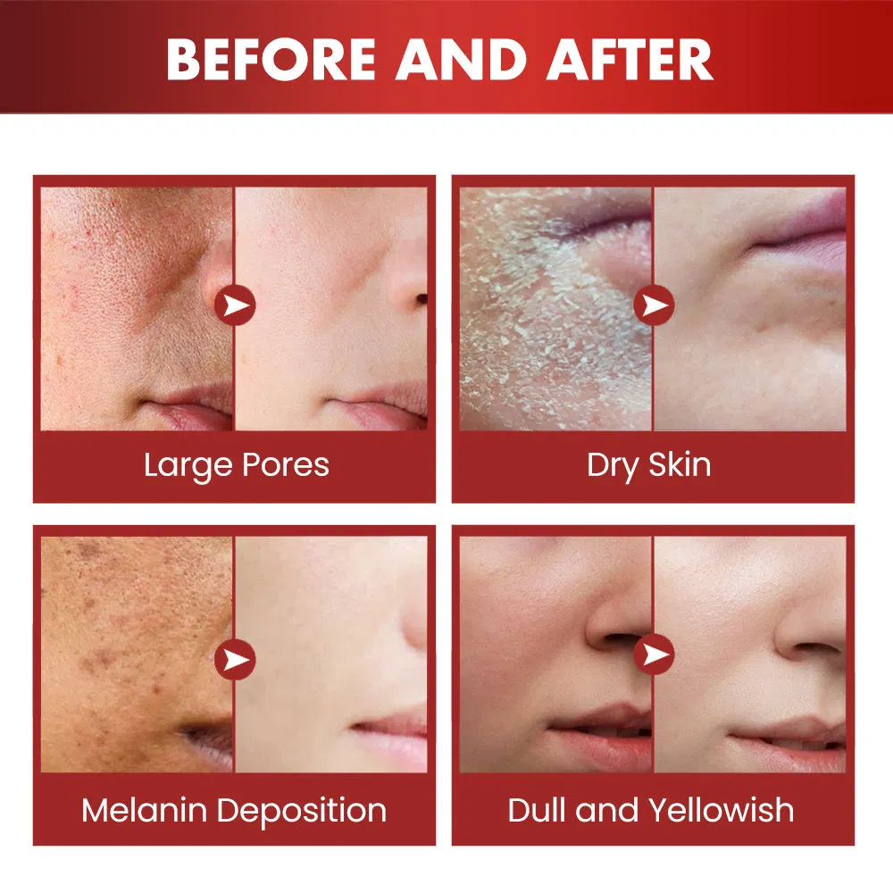 Natural Salicylic Acid Niacinamide Serum for Acne Oil Control Reducing Pigmentation