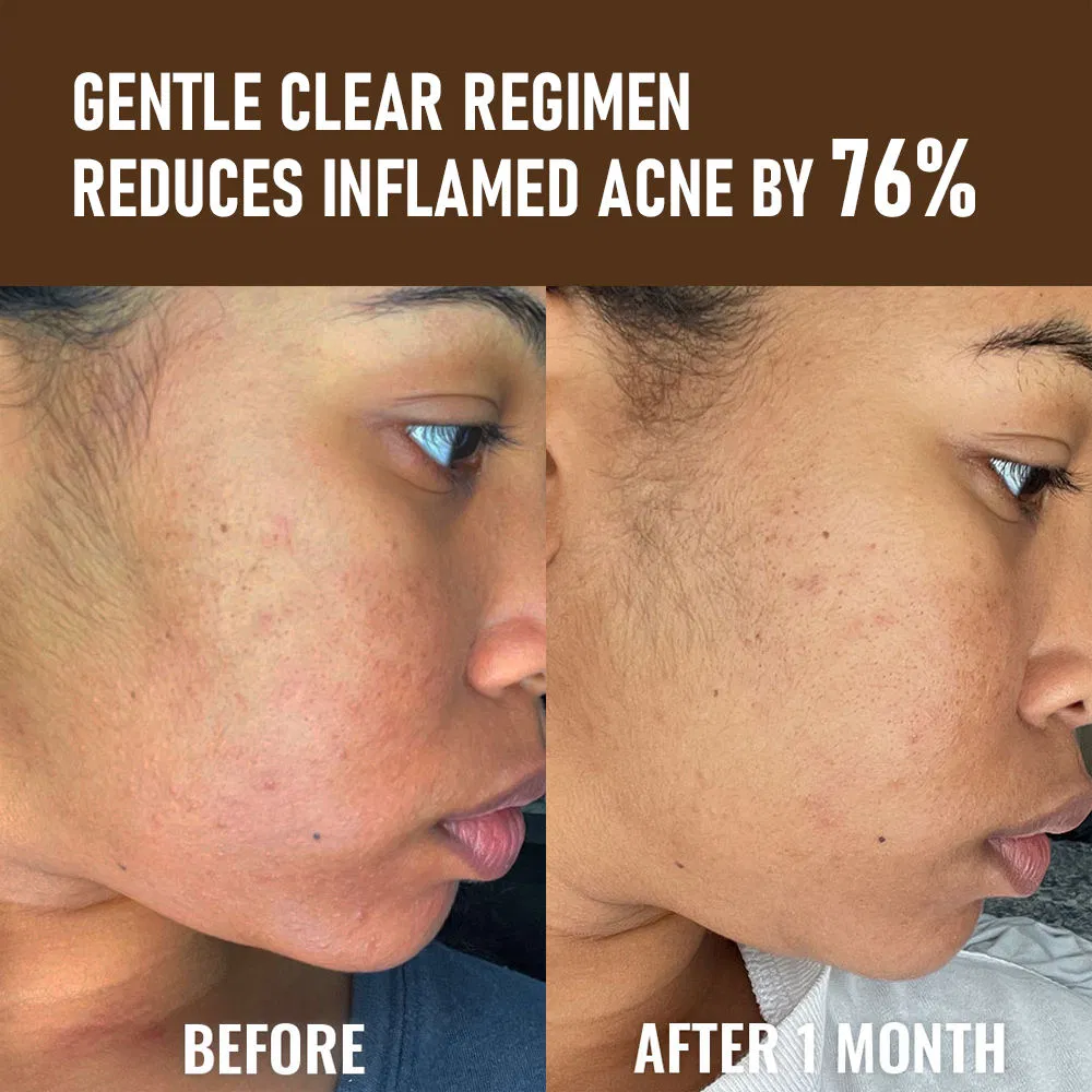 Natural Salicylic Acid Niacinamide Serum for Acne Oil Control Reducing Pigmentation