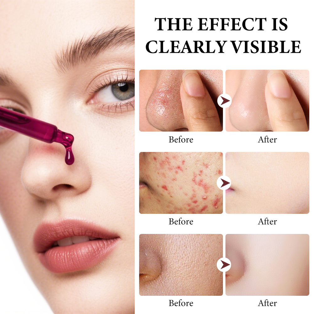 Private Label OEM AHA 8%+BHA 2% Face Serum Direct Factory 10-minutes Exfoliating Solution Deep Peeling 30ml MOOYAM Facial Serum