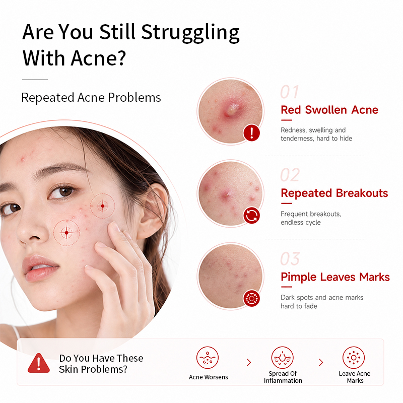OEM/ODM Anti Acne Face Serum Niacinamide Organic Salicylic Acid for Pores Dark Spots Wrinkle Reduction Improves Skin Texture