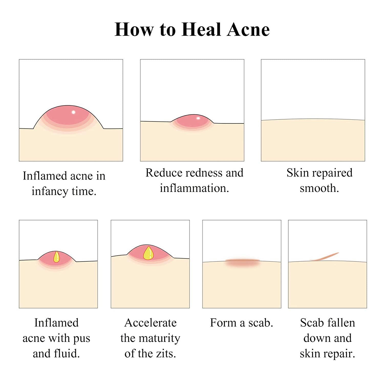 Tea Tree Acne Treatment Serum Photo 4