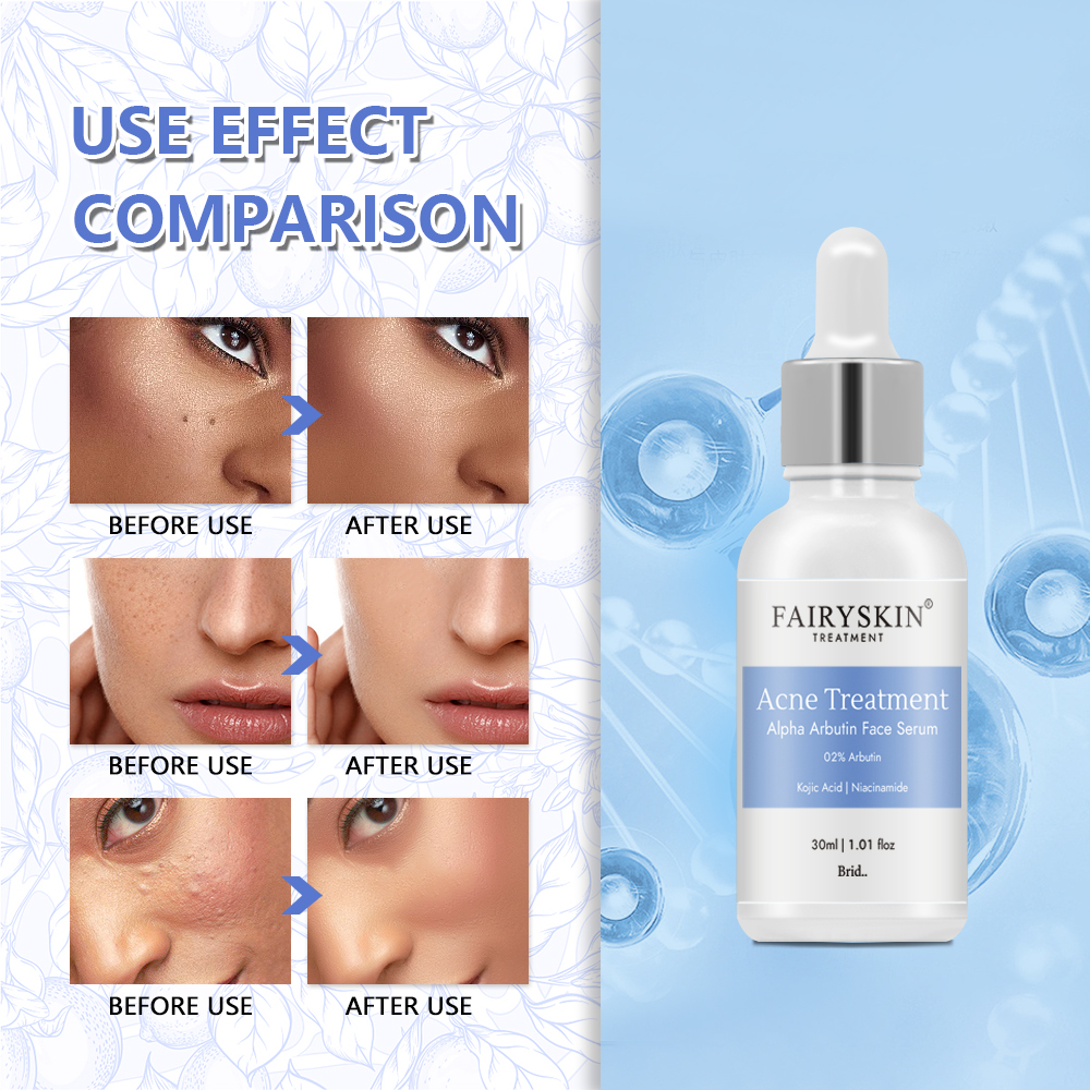 OEM Anti Acne Serum for Skin Care Kojic Acid Private Label Whitening Alpha Arbutin Face Serum for Anti Acne Products