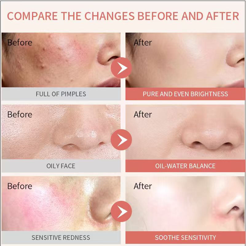 Big Drop Spot Anti-Blemish Serum Rapid Astringent Emergency Anti-Acne Pimple Removal Reduces Redness and Inflammation