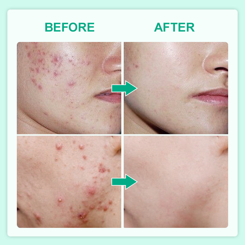 Acne Serum Product Display 8