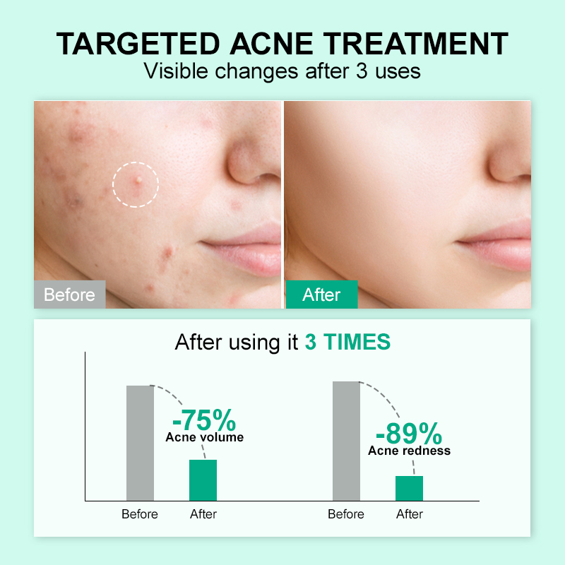 OEM Private Label Organic Whitening Anti Age Facial Serum Dark Spots Remover Double Effect Acne Removing Serum