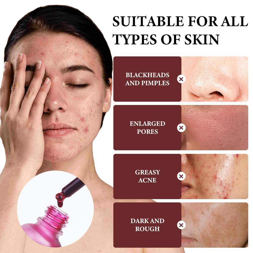 Private Label OEM AHA 8%+BHA 2% Face Serum Direct Factory 10-minutes Exfoliating Solution Deep Peeling 30ml MOOYAM Facial Serum