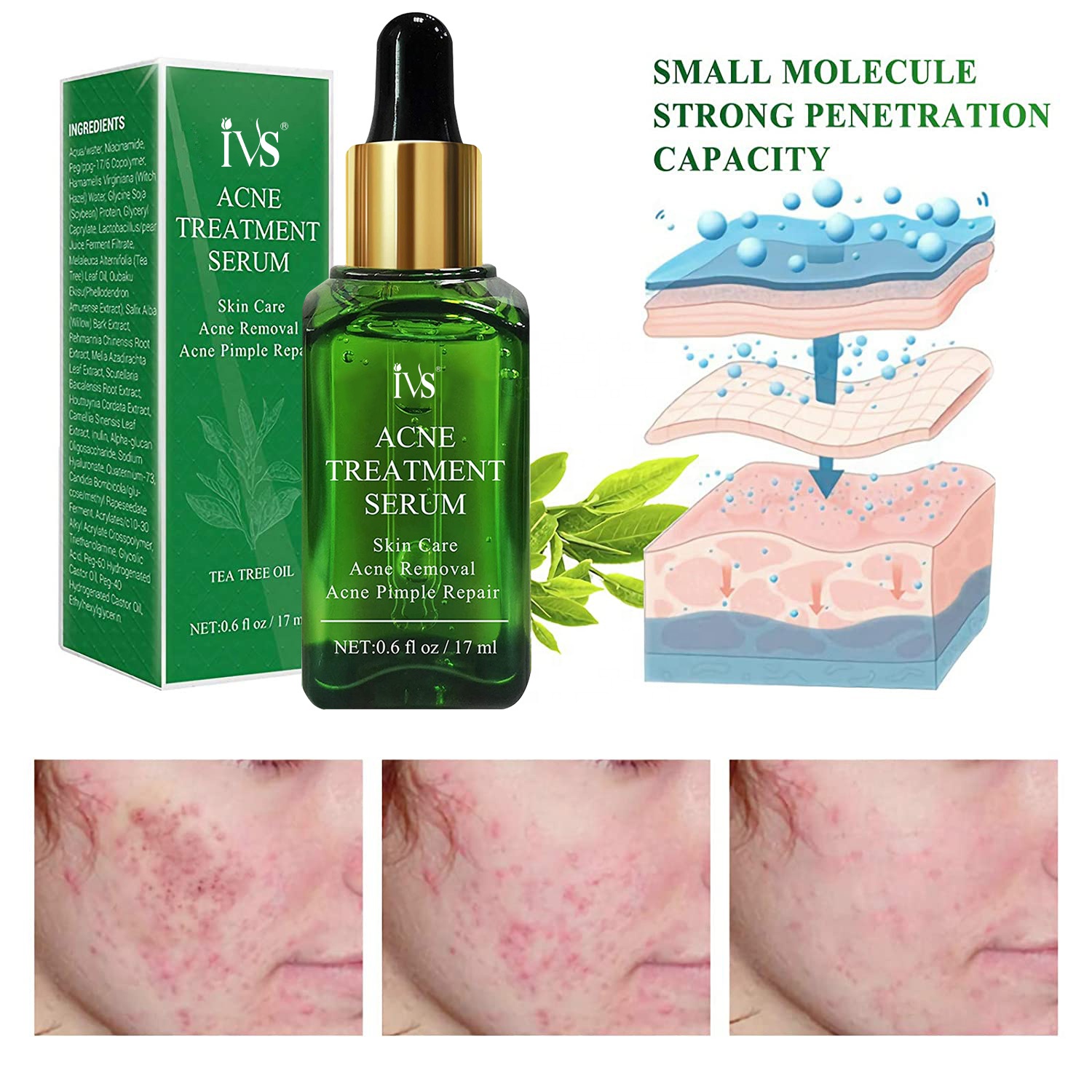 Wholesale Private Label Face Skin Product Tea Tree Acne Treatment Serum for Clearing Severe Acne, Breakout, Remover Pimple