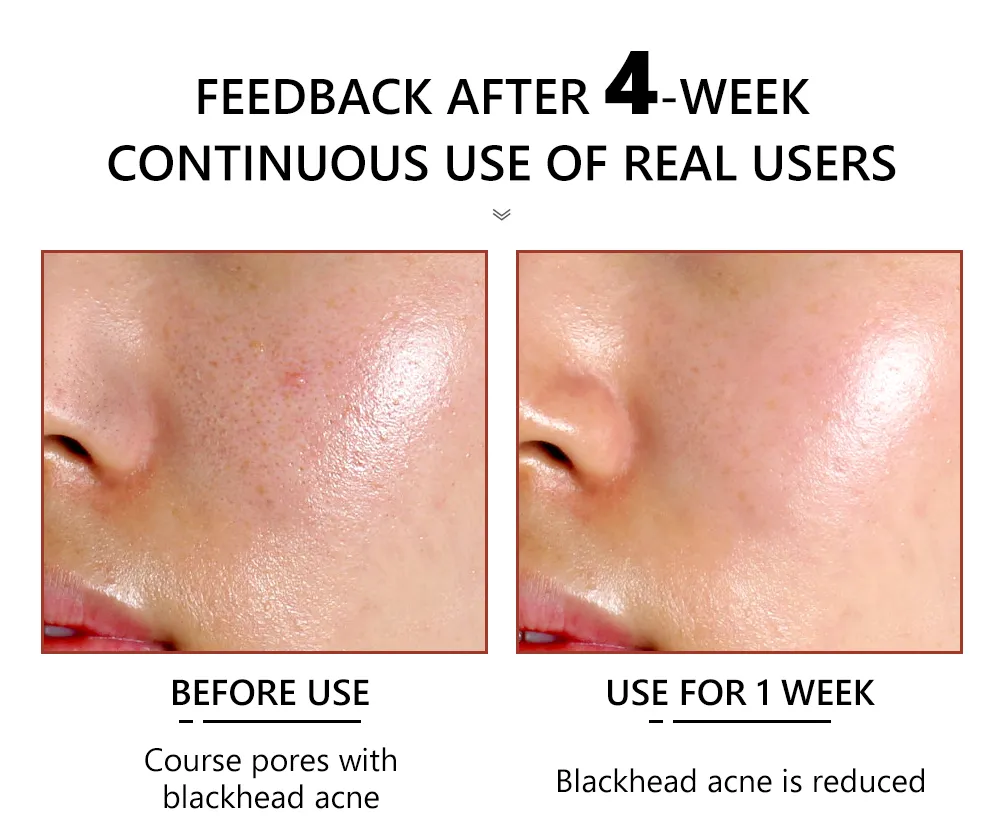 Pore Minimizer Face Serum Multi-Step Solution for Shrinking Pores, Cleansing, Oil Control Serum