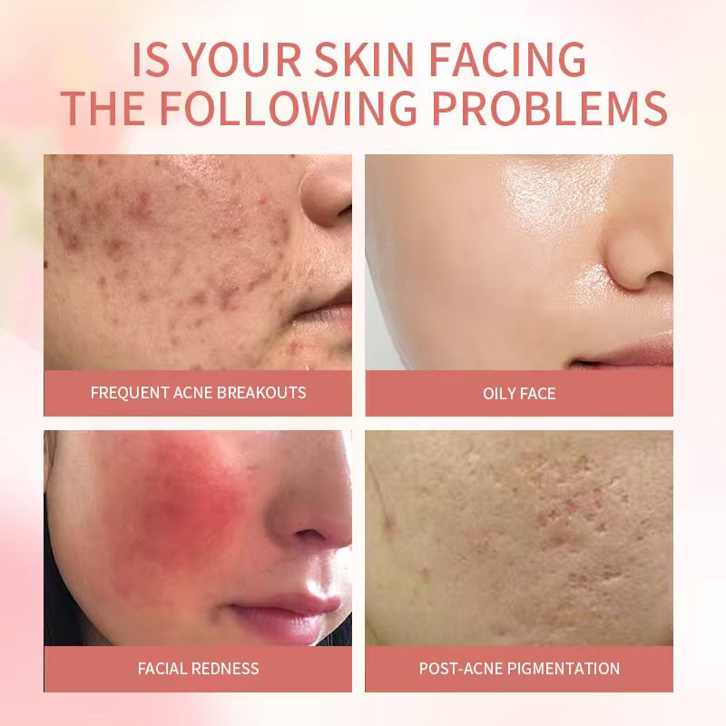 Big Drop Spot Anti-Blemish Serum Rapid Astringent Emergency Anti-Acne Pimple Removal Reduces Redness and Inflammation