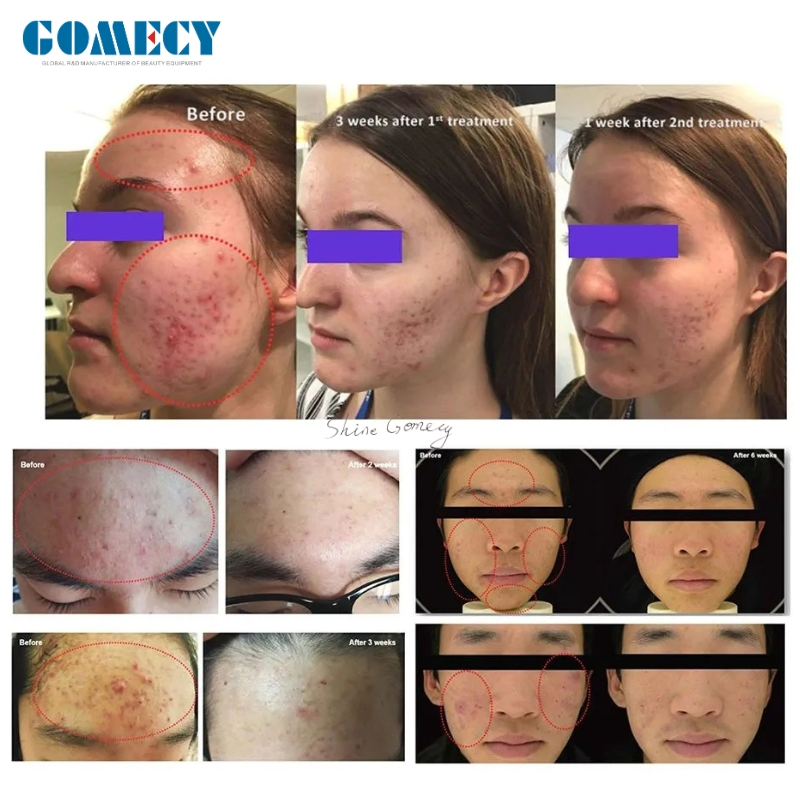 Newest Ozone Therapy Plasma Pen Ozone Plasma Pen EMS Facial Massager EMS Facial Lifting Beauty Equipment Acne Treatment for Anti Aging