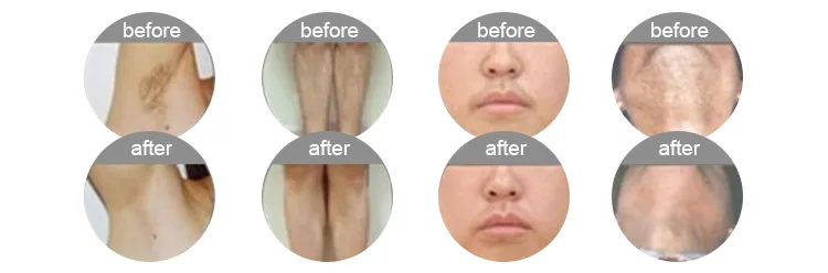 Laser Treatment Scope