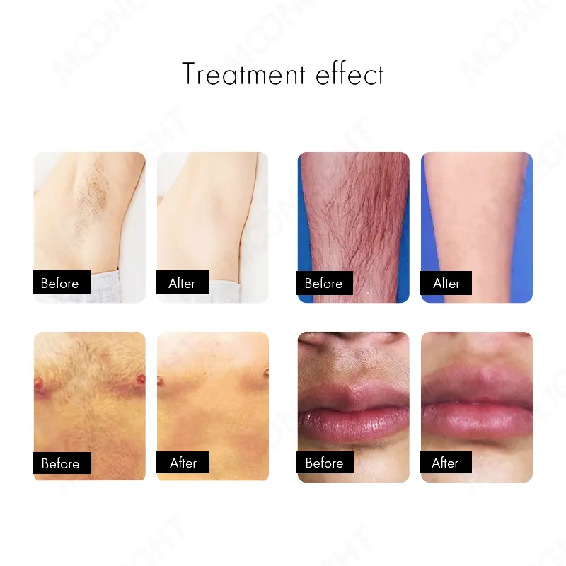 Laser Bar Technology