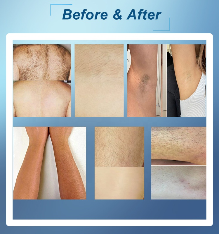 50% off High Power 1000W 1200W Diode Laser Hair Removal 808 Beauty Medical Equipment