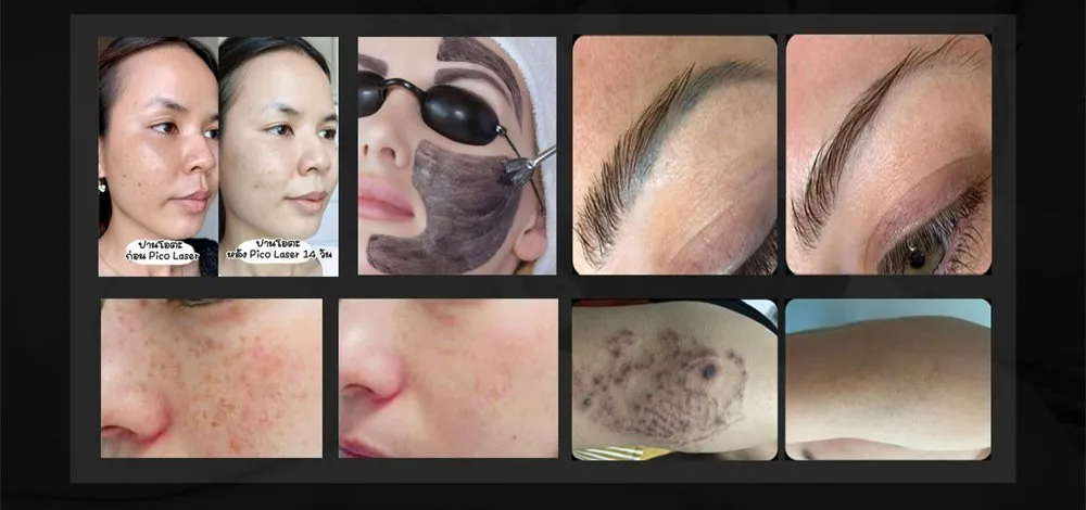 Tattoo Removal Result