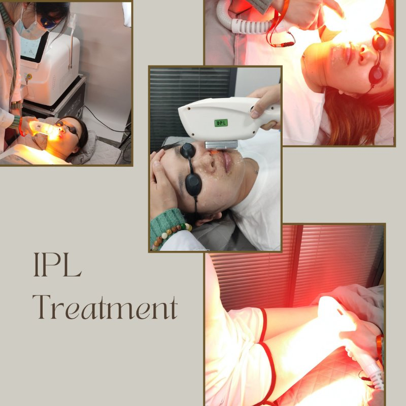 High Frequency IPL System 1000W for Rapid Body Hair Removal and Rejuvenation