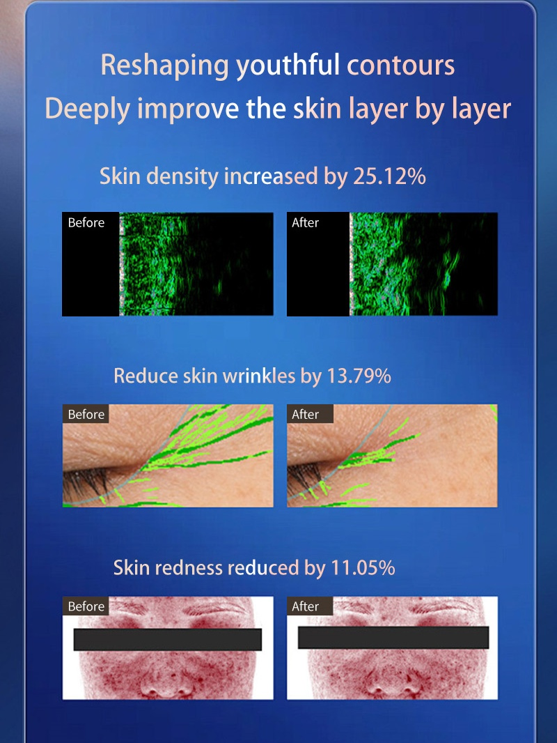 Gold 3-in-1 Skin Treatment Device with RF-Hifu and Ice Hammer