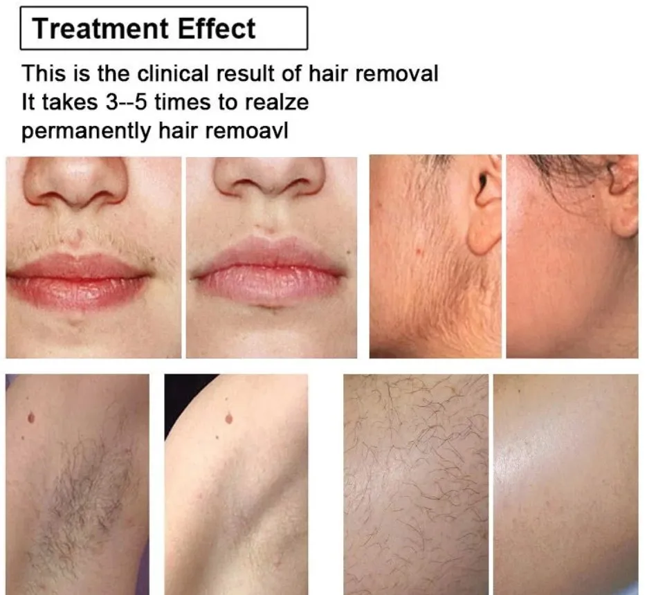 Handpiece Comparison
