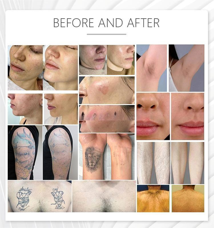 M22 Laser Acne Treatment IPL ND YAG Vascular Removal Hair Removal Machine