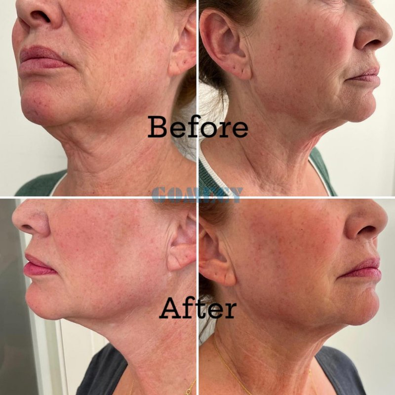 Multi-Function 980+1470nm Diode Laser System for Spider Veins and Skin Rejuvenation